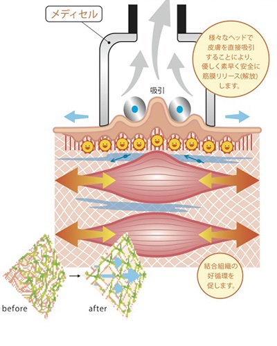 鍼と筋膜リリースで不調を根本から改善します